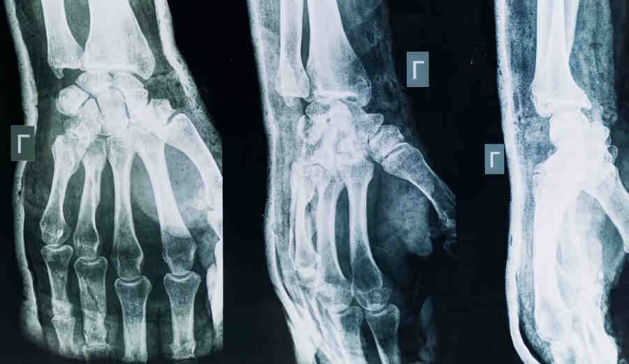 Проблема - нарушение обмена веществ в костных тканях