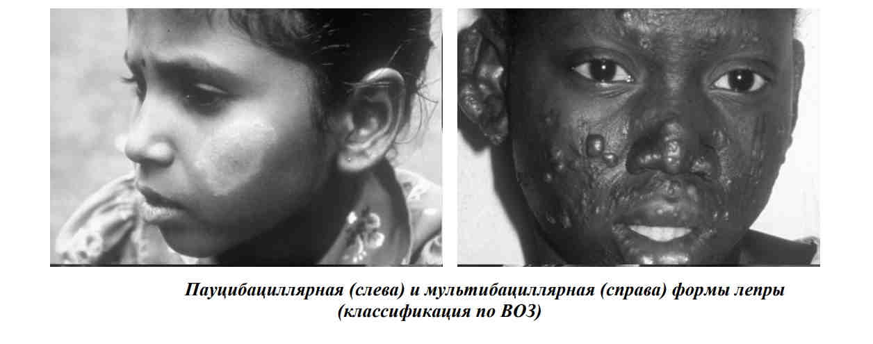 Пауцибациллярная (слева) и мультибациллярная формы лепры