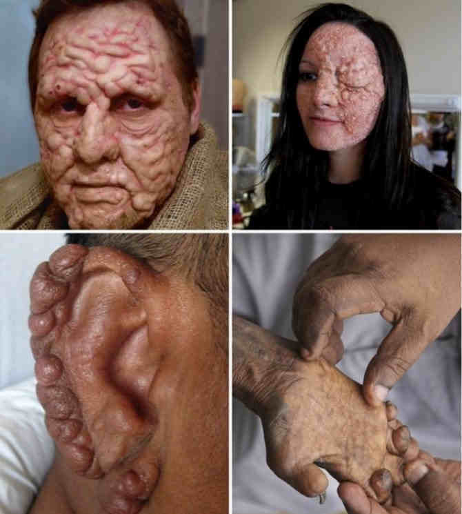 Заболевшие проказой Заболевшие проказой