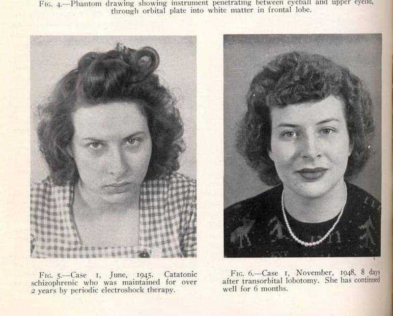 Пациенты, перенесшие психохирургическое вмешательство Пациенты, перенесшие психохирургическое вмешательство