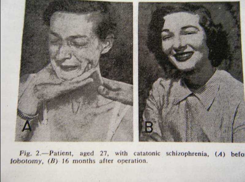 Пациенты, перенесшие психохирургическое вмешательство Пациенты, перенесшие психохирургическое вмешательство