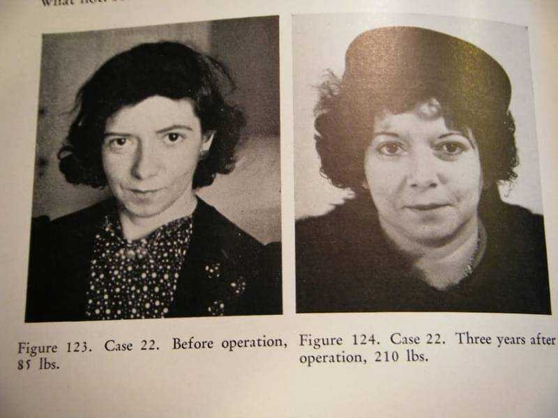 Пациенты, перенесшие психохирургическое вмешательство Пациенты, перенесшие психохирургическое вмешательство