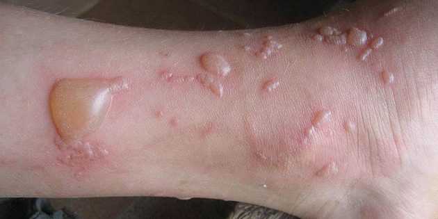 Характерные ожоги от Борщевика