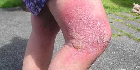 Ещё один ожог от Борщевика